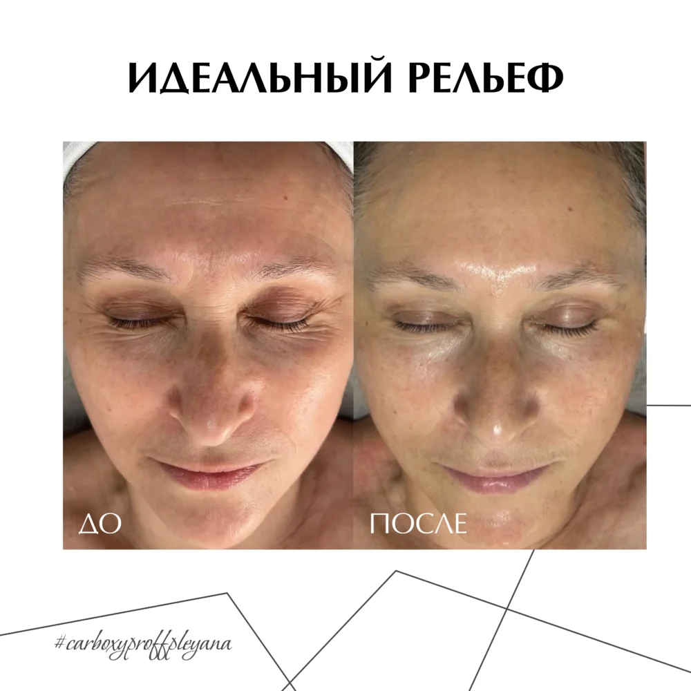 Активный гель для карбокситерапии CARBOXY PROFF pH8.0-8.5 200мл / Pleyana / — изображение 8